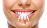Этапы и особенности имплантации зубов