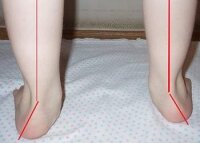 Х-образная деформация ног – методы лечения