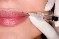 Методика увеличения губ гиалуроновой кислотой